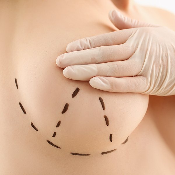 Breast Lift