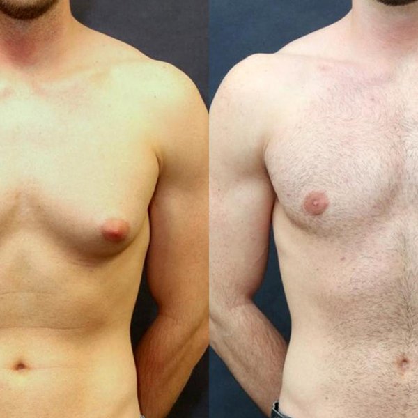 Gynecomastia