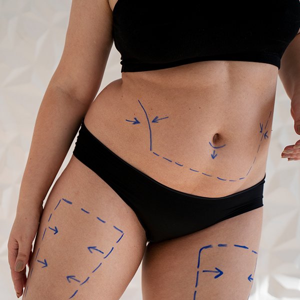 Liposuction