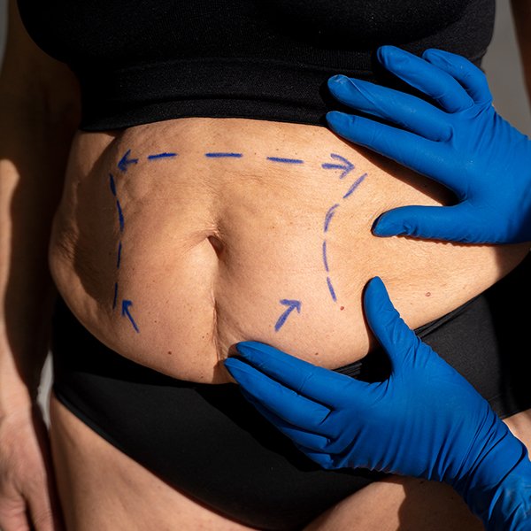 Tummy Tuck - Abdominoplasty